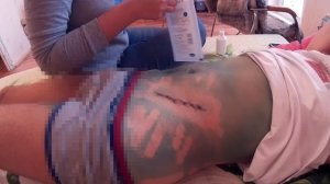 Перевязка с использованием пластыря Космопор