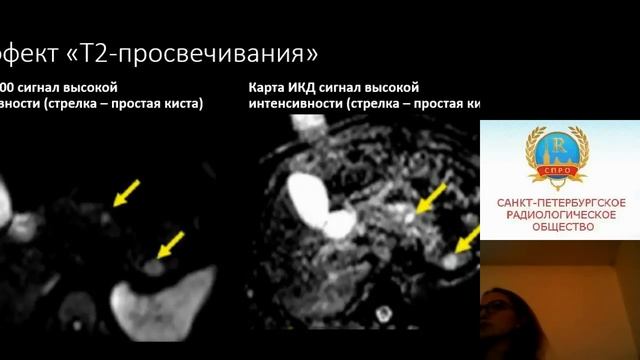 Mартьянова О.С. "Особенности МР-диффузии при при заболевании поджелудочной железы" смотреть онлайн