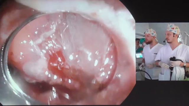 09Live Смирнов АА Подслилистое новообразование желудка Туннельная резекция GIST STER