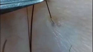 Удаление вросших волос пинцетом