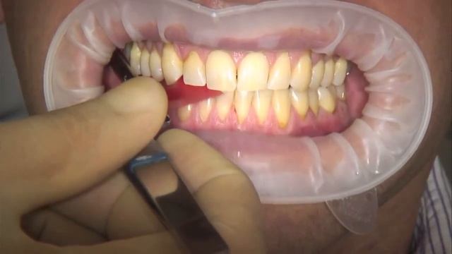 Артикуляционная фольга Arti Fol® 8µ