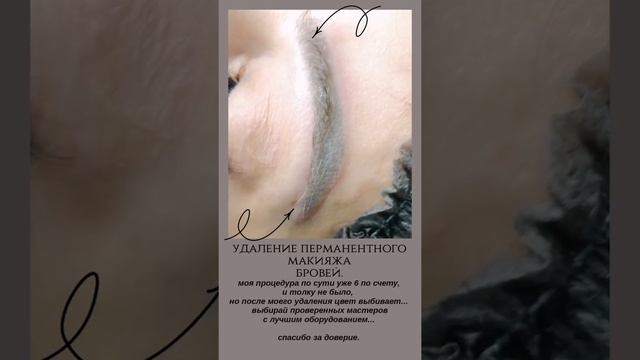 Удаление перманентного макияжа бровей лазером в студии красоты @lindelin_kms смотреть онлайн