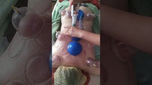 МАССАЖ ВАКУУМНЫМИ БАНКАМИ