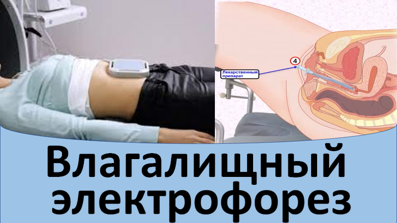 Влагалищный электрофорез смотреть онлайн
