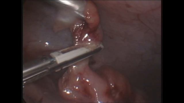 Безлигатурная лапароскопическая аппендэктомия у детей