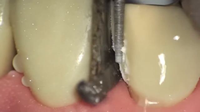 Препарирование под коронку смотреть онлайн