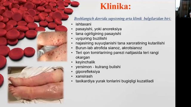 Bolalarda Sepsis Kasalligi