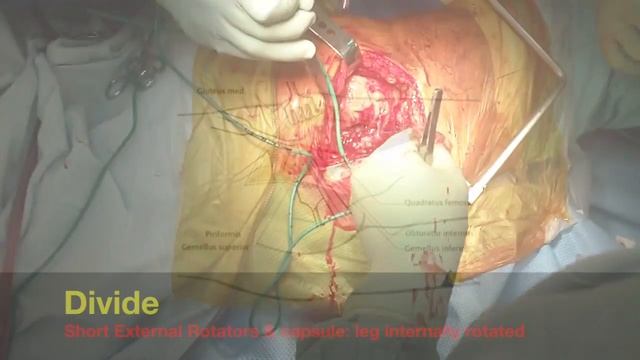 Posterior Approach to the hip смотреть онлайн