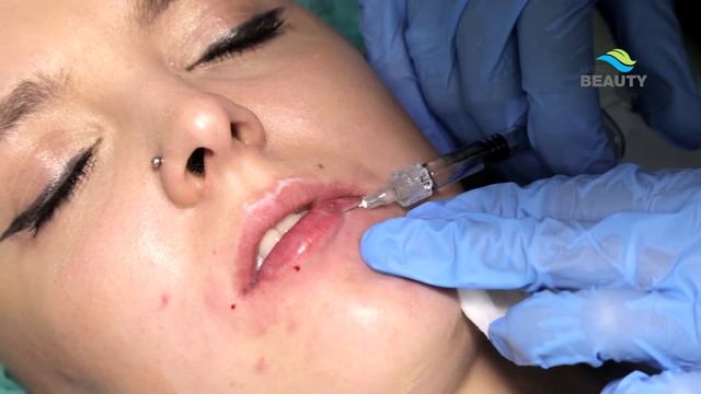 Объемное моделирование нижней трети лица. Коррекция губ