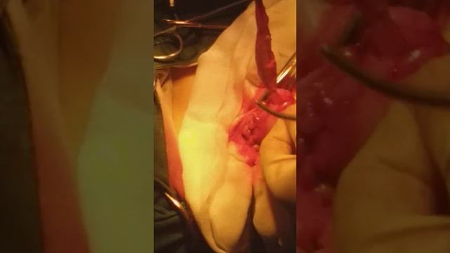 удаление червеобразного отростка смотреть онлайн