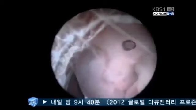 ЭКО - экстракорпоральное оплодотворение (IVF)