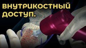 Внутрикостный доступ #ПроСМП