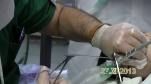 бронхоскопия у детей. удаление инородного тела дыхательных путей