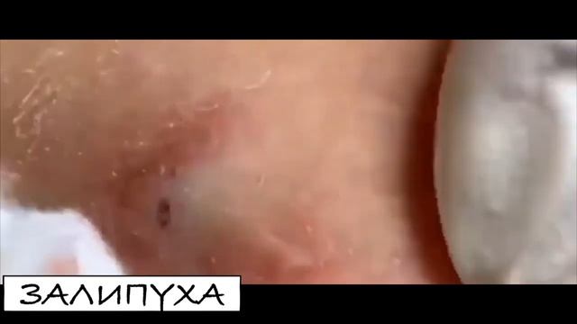 ПРЫЩИ ВЫДАВЛИВАНИЕ. ВЫДАВЛИВАНИЕ ПРЫЩЕЙ. ВЫДАВЛИВАНИЕ ЧЕРНЫХ ПРЫЩЕЙ НА ЛИЦЕ. #прыщи #acne #asmr