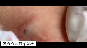 ПРЫЩИ ВЫДАВЛИВАНИЕ. ВЫДАВЛИВАНИЕ ПРЫЩЕЙ. ВЫДАВЛИВАНИЕ ЧЕРНЫХ ПРЫЩЕЙ НА ЛИЦЕ. #прыщи #acne #asmr