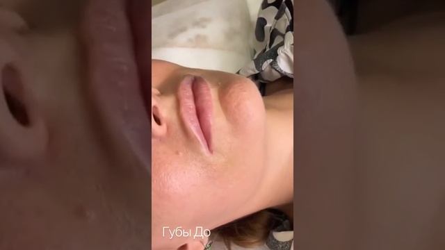 увлажнение губ биоревитализантом veronica revital expert смотреть онлайн