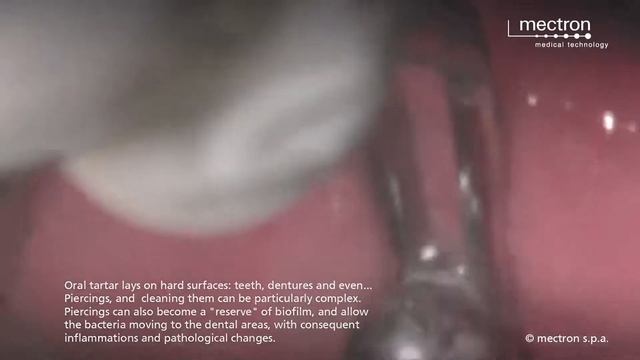 Пирсинг языка: уход и профессиональная чистка смотреть онлайн