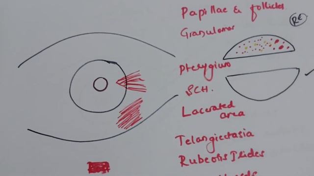 Colour coding -- Anterior segment lesions/ Conjunctival lesions/ Iris lesions смотреть онлайн