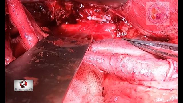 Lateral Pelvic Lymph Node Dissection in Locally Advanced Tumor/Латеральная тазовая лимфодиссекция смотреть онлайн