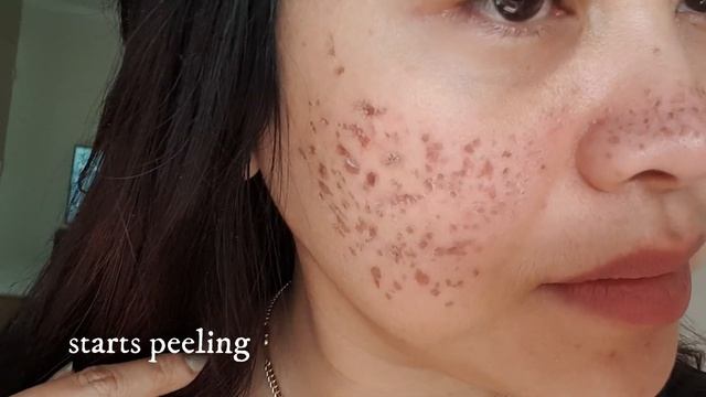 DIY TCA Cross 100% at Home/8 Days Update Before and After/BelleLife Tv смотреть онлайн