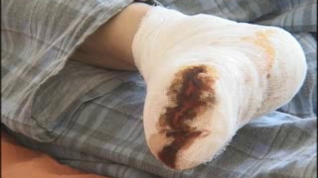 обморожения смотреть онлайн