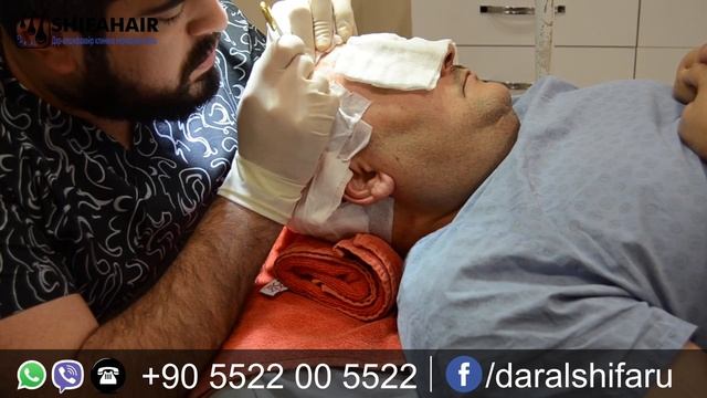 фрагмент трансплантации волос в ДарАльШифа хейр +905522005522 смотреть онлайн