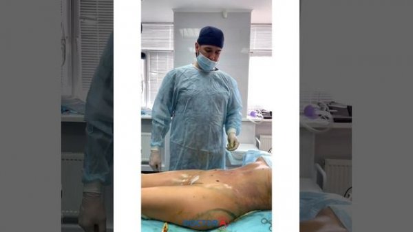 Липоскульптура тела с липофилингом ягодиц