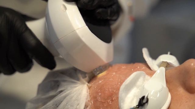 Процедура фотоомоложение IPL Lumecca — Клиника Реконструктивной Косметологии смотреть онлайн