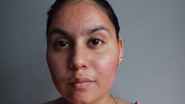 How to get rid of acne |The Ordinary Aha 30 + Bha 2 Peeling Solution смотреть онлайн