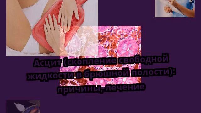 Асцит (скопление свободной жидкости в брюшной полости): причины, лечение смотреть онлайн