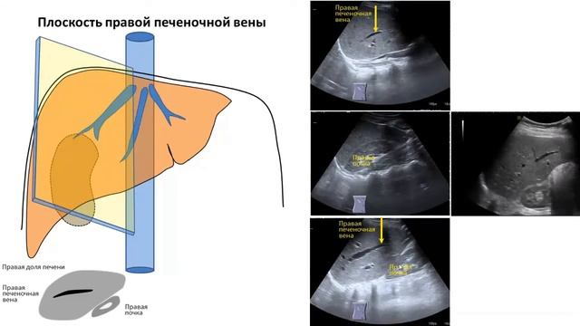 Плоскости ультразвукового сканирования печени смотреть онлайн