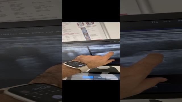 Атеросклероз. Высокий холестерин. Узи сосудов. Сосудистый хирург. Флеболог. Флеболог Москва смотреть онлайн