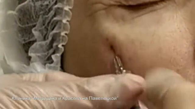 Коррекция носослезной борозды в клинике 