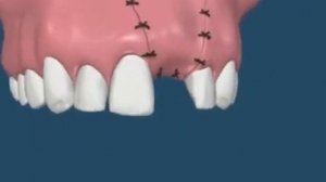 Наращивание кости с имплантацией зубов