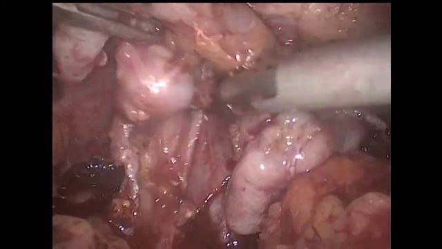 Laparoscopic Prostatectomy  / Лапароскопическая простатэктомия