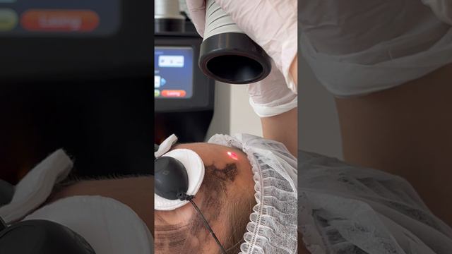 Карбоновый пилинг - идеальное решение против черных точек и расширенных пор | сеть клиник GEN87 смотреть онлайн