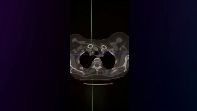 CT assessment - how to analyse station 1 lymph nodes смотреть онлайн