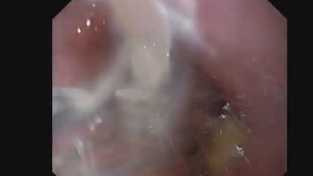 Foreign body removal from esophagus (artificial denture ). смотреть онлайн