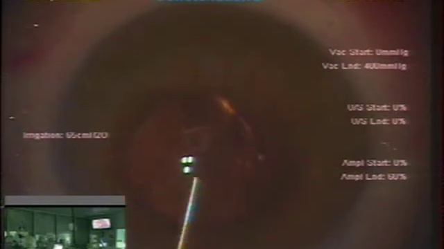 scleral tunnel aphakic ARTISAN IOL implantation, Kanellopoulos MD JUL13 смотреть онлайн