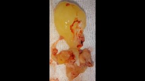 Инвертированная папиллома носа #лорврач #гайморит #искривление #полипыноса #аденоиды #ринит