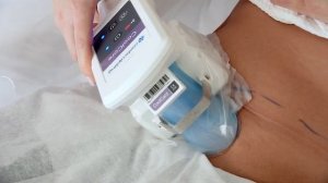 Как убрать живот и бока за короткий срок. Криолиполиз - коррекция фигуры на аппарате Зелтик