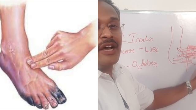 Foot Ulcer In Diabetes How To Control In Tamil | Doctor Karthikeyan