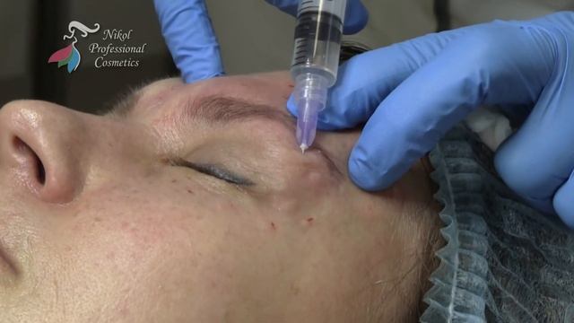 Процедура БИОРЕВИТАЛИЗАЦИИ от TM Nikol Professional Cosmetics. смотреть онлайн