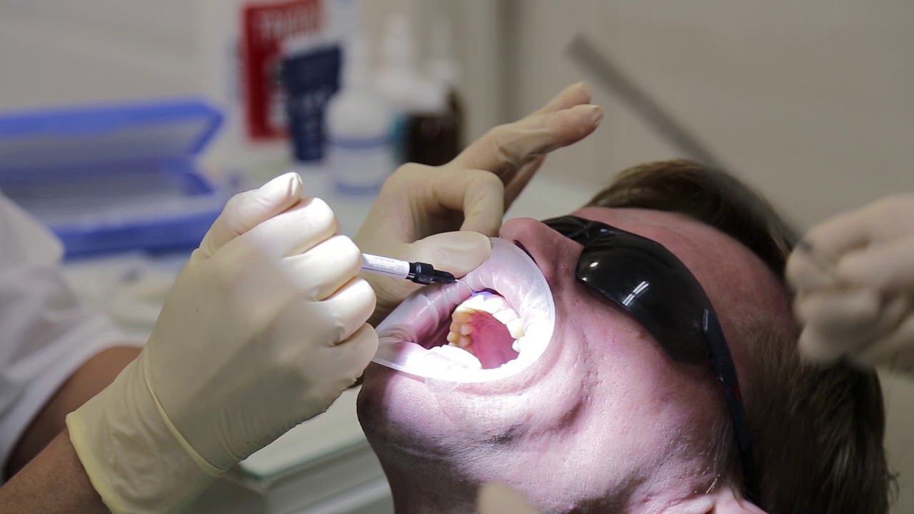 Офисное отбеливание в первой семейной стоматологии "Лайт" смотреть онлайн