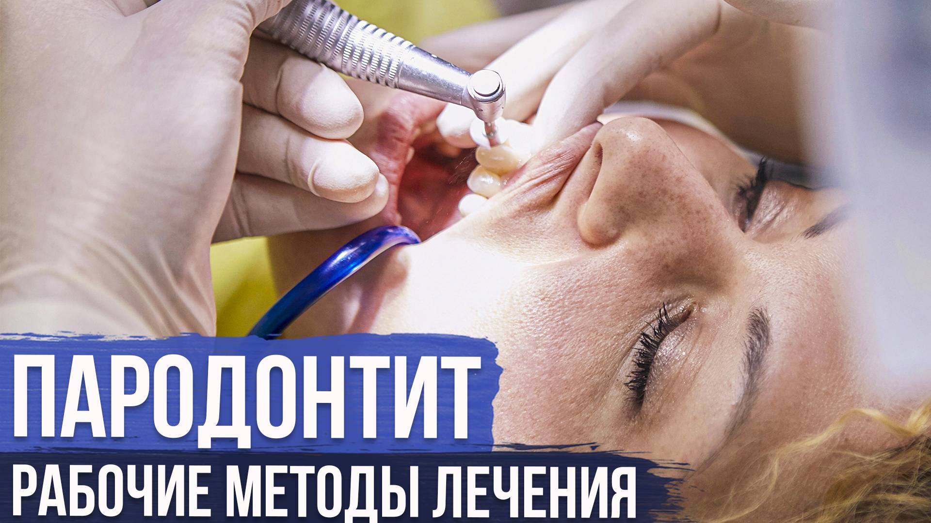 Все О Лечении Пародонтита: Как Предотвратить Потерю Зубов смотреть онлайн