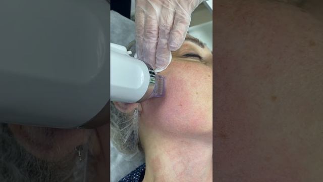 Семинар - обучение «Микроигольчатый РФ-лифтинг» смотреть онлайн