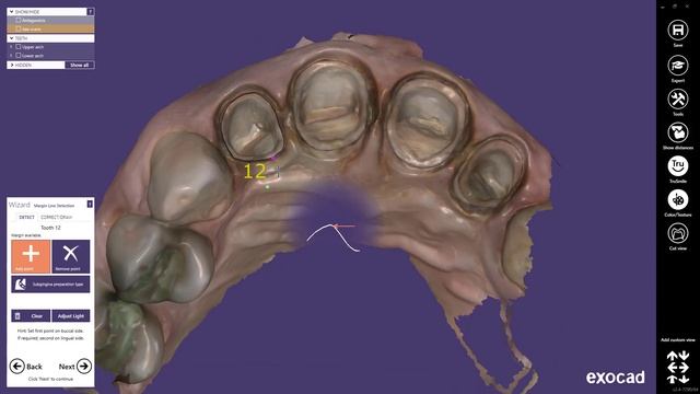 exocad Video Tutorial: Model Creator смотреть онлайн