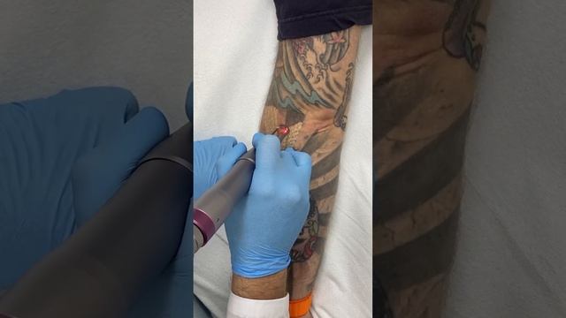 Удаление татуировок ﻿и татуажа смотреть онлайн