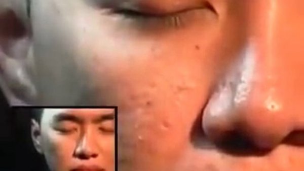 ШОК! Черви лезут из лица человека