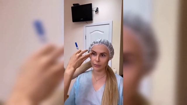 Верхняя Блефаропластика. Upper Blepharoplasty ★ DUZHY смотреть онлайн
